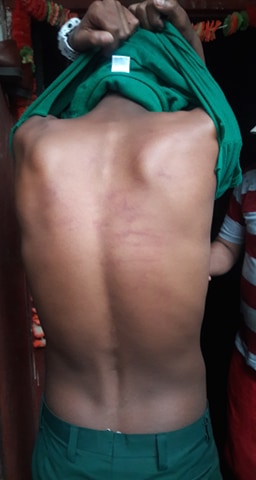 शिक्षकको कुटाइबाट विद्यार्थी घाईते, शिक्षकद्वारा गल्ती स्विकार, उपचार खर्च व्यहोर्ने  सर्त 